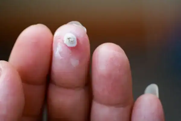 Image of white wart before cryopen treatment Rochester
