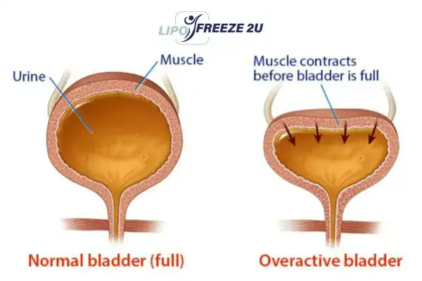 diagram of overactive bladder treatment Rochester