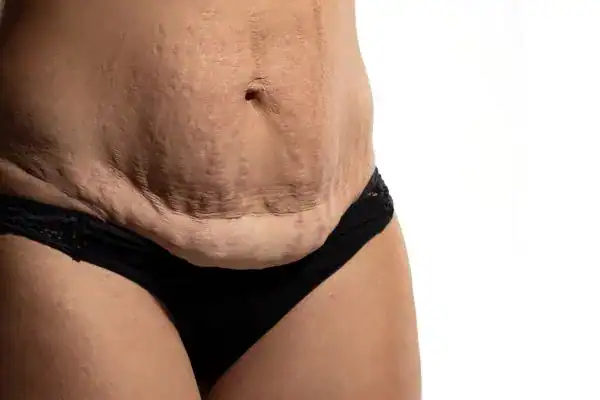 loose skin after weight loss injections Rochester