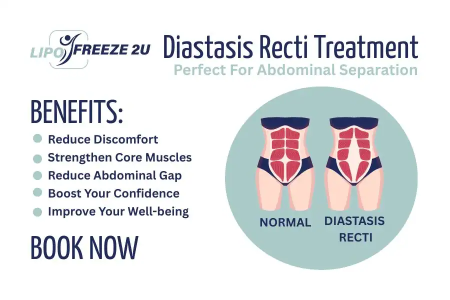 How Long Will It Take to See Improvements in Diastasis Recti Rochester