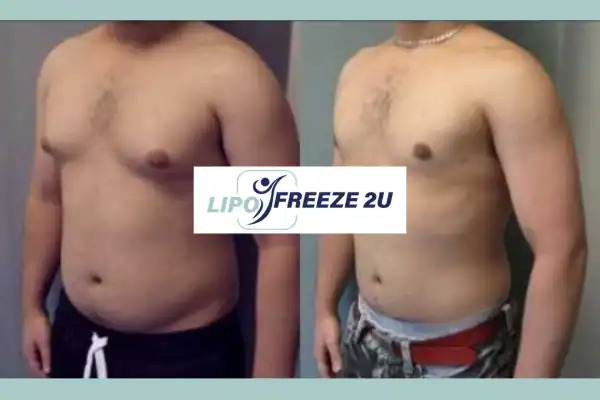 How Long Does It Take to See Results Rochester?
