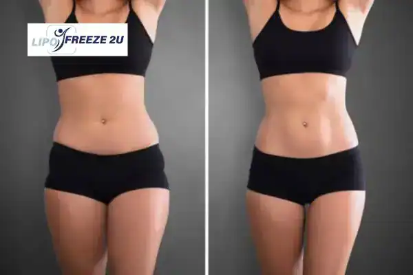 How Can LIPO FREEZE 2U Support Your Post-Pregnancy Body Recovery Rochester?
