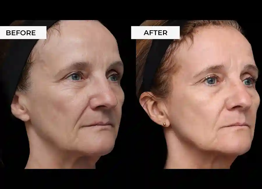 How Many RF Microneedling Sessions Will You Need to See a Difference Rochester?