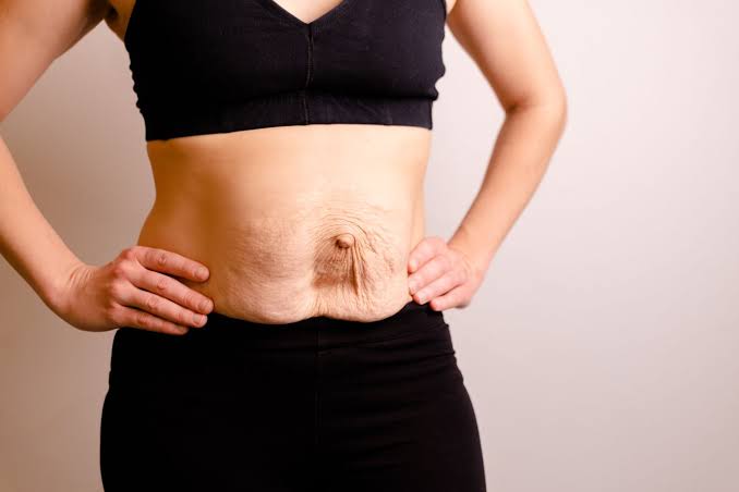 Is Surgery Really the Only Way to Repair Diastasis Recti Rochester?