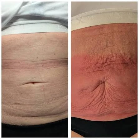 How Does RF Microneedling Improve Crepey, Thin and Uneven Skin Texture Rochester?
