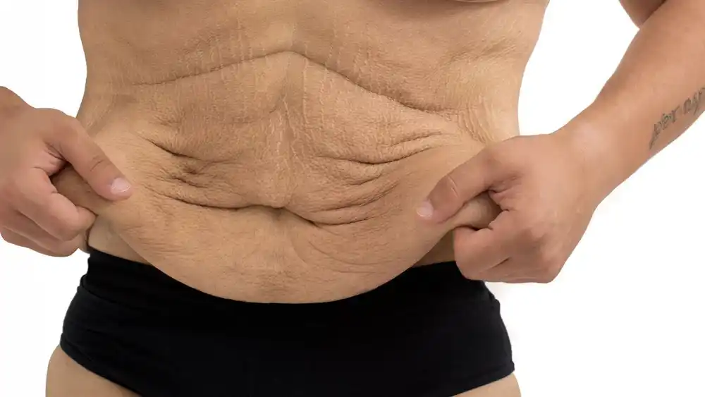 RF Microneedling for Loose Skin: How Can It Help Tighten and Reshape the Skin Rochester?